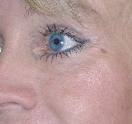 After Image: Fat Grafting Face: Case 1 - left-front-oblique
