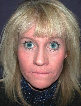 Before Image: Fat Grafting Face: Case 1 - front