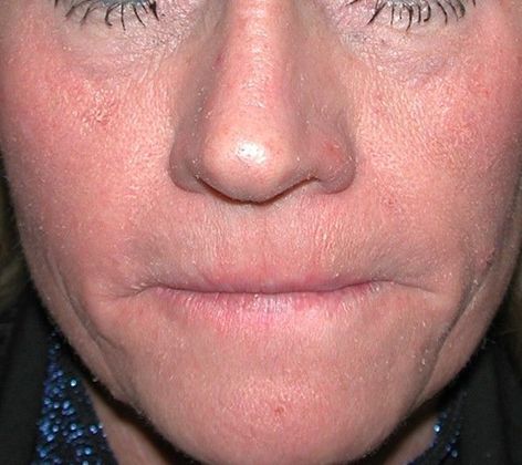 Before Image: Fat Grafting Face: Case 1 - front