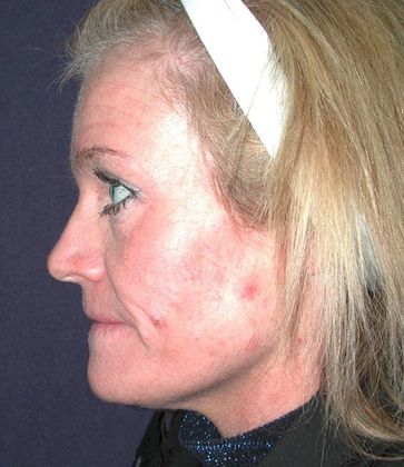 Before Image: Fat Grafting Face: Case 1 - left-side