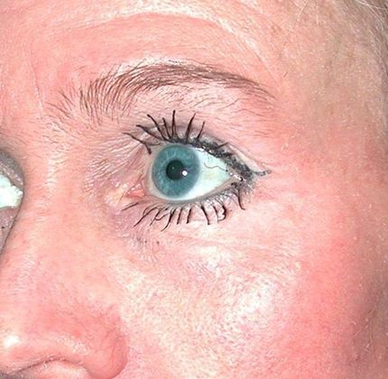 Before Image: Fat Grafting Face: Case 1 - left-front-oblique