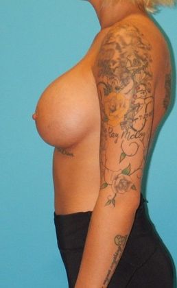 After Image: Breast Augmentation: Case 1 - left-side