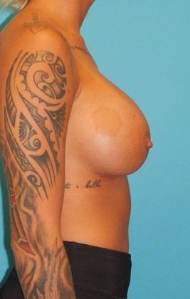 After Image: Breast Augmentation: Case 1 - right-side