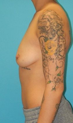 Before Image: Breast Augmentation: Case 1 - left-side