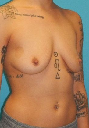 Before Image: Breast Augmentation: Case 1 - right-front-oblique