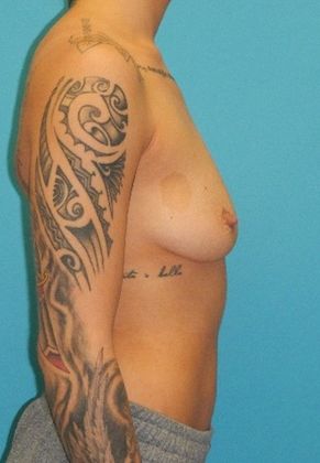 Before Image: Breast Augmentation: Case 1 - right-side