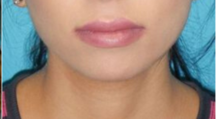 After Image: Lip Augmentation: Case 1 - front
