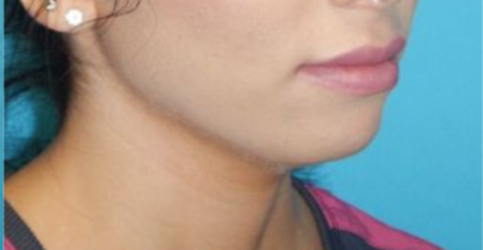 After Image: Lip Augmentation: Case 1 - right-front-oblique