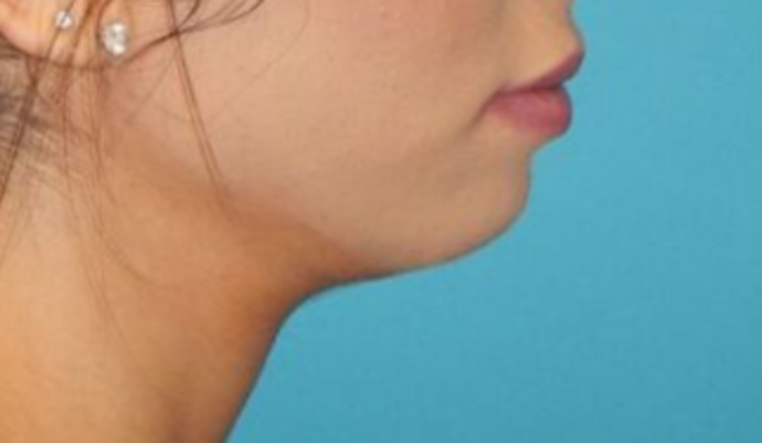 After Image: Lip Augmentation: Case 1 - right-side