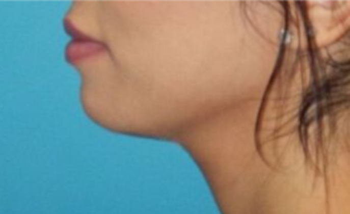 After Image: Lip Augmentation: Case 1 - left-front-oblique