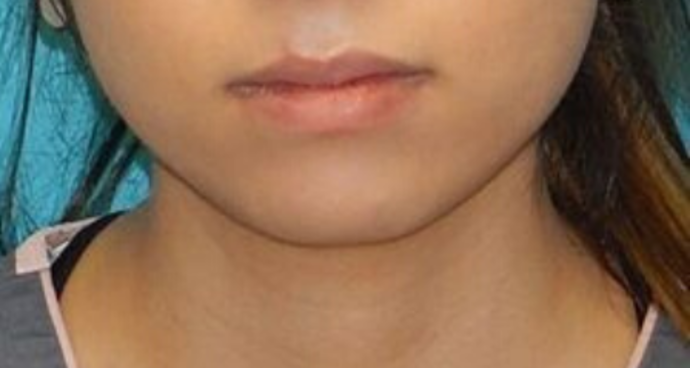 Before Image: Lip Augmentation: Case 1 - front