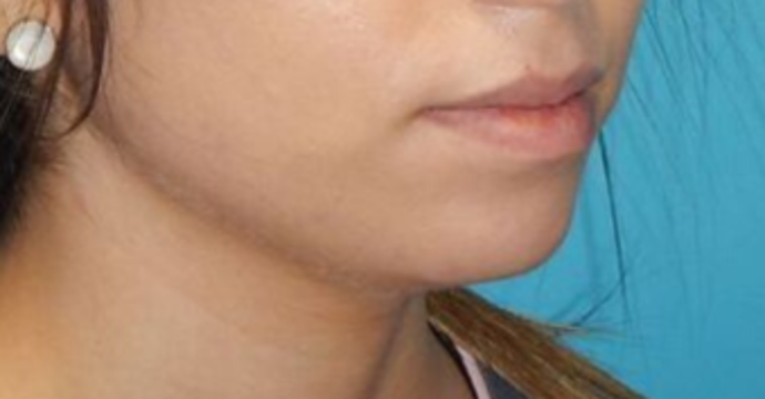 Before Image: Lip Augmentation: Case 1 - right-front-oblique