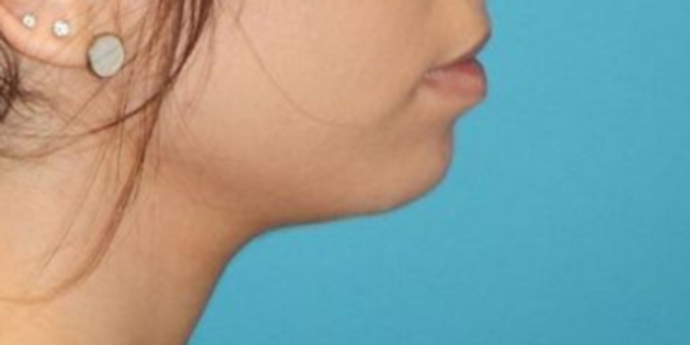 Before Image: Lip Augmentation: Case 1 - right-side