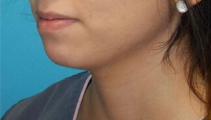 Before Image: Lip Augmentation: Case 1 - left-front-oblique
