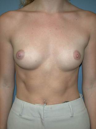Before Image: Breast Augmentation: Case 10 - front
