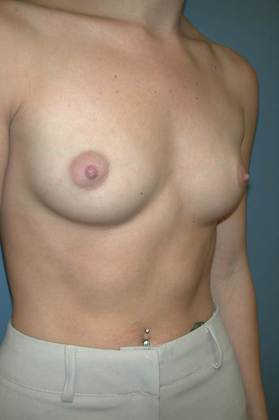 Before Image: Breast Augmentation: Case 10 - right-front-oblique