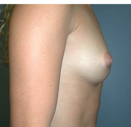 Before Image: Breast Augmentation: Case 10 - right-side