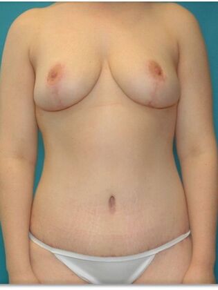 After Image: Abdominoplasty: Case 10 - front