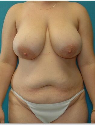 Before Image: Abdominoplasty: Case 10 - front