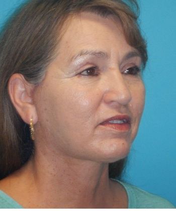 After Image: Mini Facelift: Case 10 - right-front-oblique