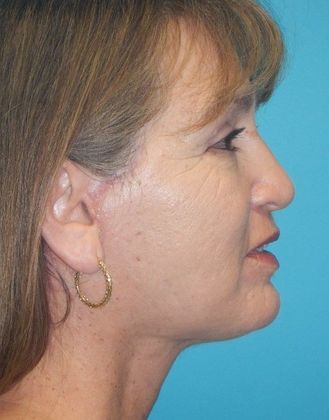 After Image: Mini Facelift: Case 10 - right-side