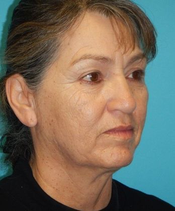 Before Image: Mini Facelift: Case 10 - right-front-oblique