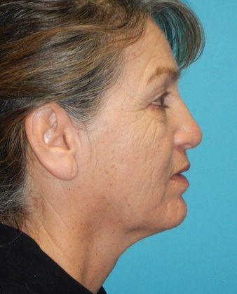 Before Image: Mini Facelift: Case 10 - right-side