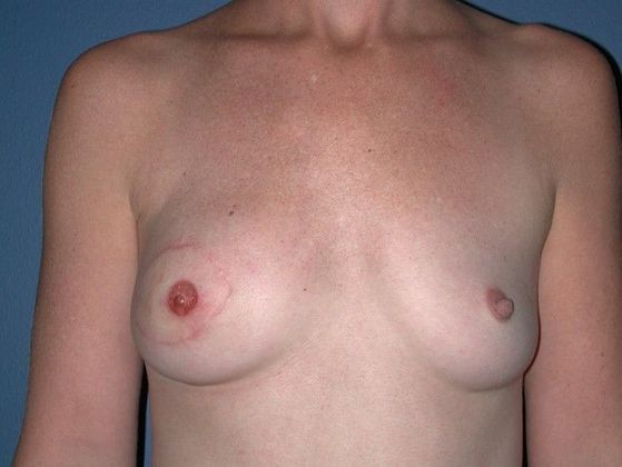 After Image: Breast Reconstruction: Case 10 - front