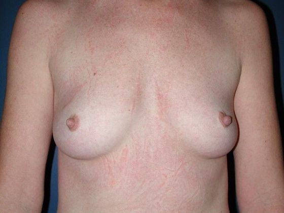 Before Image: Breast Reconstruction: Case 10 - front