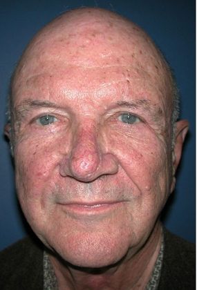 After Image: Eye Lift (Blepharoplasty): Case 10 - front