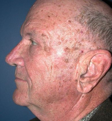 After Image: Eye Lift (Blepharoplasty): Case 10 - left-side