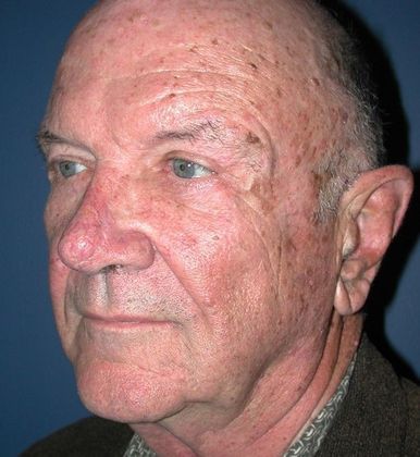 After Image: Eye Lift (Blepharoplasty): Case 10 - left-front-oblique