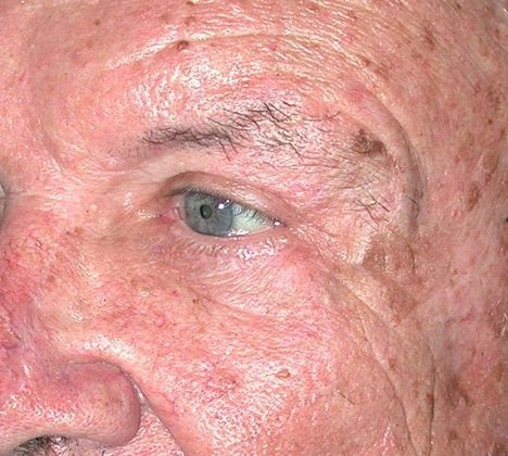 After Image: Eye Lift (Blepharoplasty): Case 10 - left-front-oblique