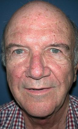 Before Image: Eye Lift (Blepharoplasty): Case 10 - front
