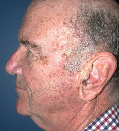 Before Image: Eye Lift (Blepharoplasty): Case 10 - left-side