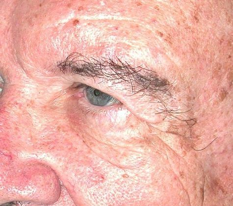 Before Image: Eye Lift (Blepharoplasty): Case 10 - left-front-oblique