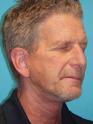 After Image: Face & Neck Lifts: Case 10 - right-front-oblique