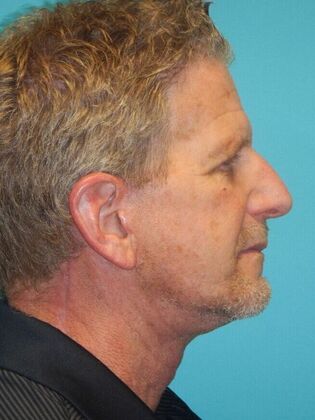 After Image: Face & Neck Lifts: Case 10 - right-side