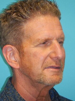 Before Image: Face & Neck Lifts: Case 10 - right-front-oblique