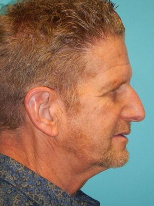 Before Image: Face & Neck Lifts: Case 10 - right-side