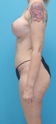 After Image: Mommy Makeover: Case 10 - left-side