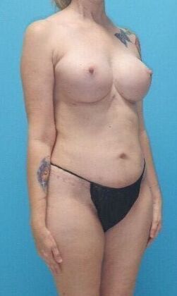 After Image: Mommy Makeover: Case 10 - right-front-oblique