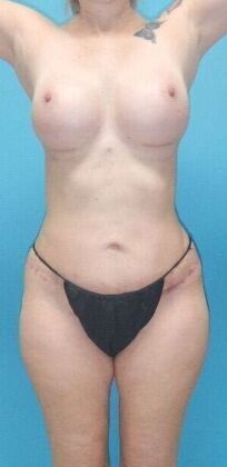 After Image: Mommy Makeover: Case 10 - front