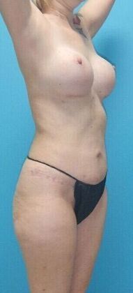 After Image: Mommy Makeover: Case 10 - right-front-oblique