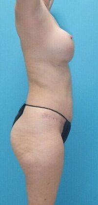 After Image: Mommy Makeover: Case 10 - right-side