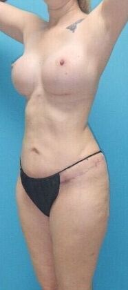 After Image: Mommy Makeover: Case 10 - left-front-oblique