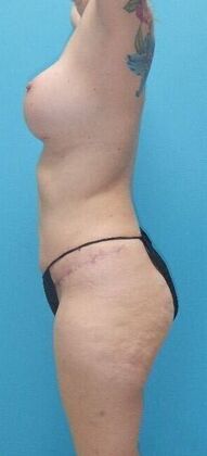 After Image: Mommy Makeover: Case 10 - left-side