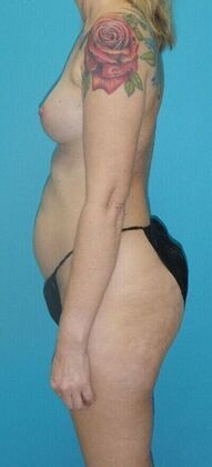 Before Image: Mommy Makeover: Case 10 - left-side