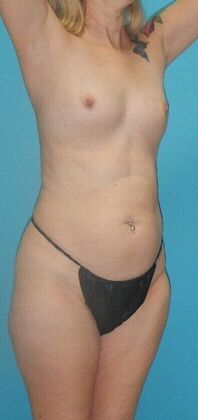 Before Image: Mommy Makeover: Case 10 - right-front-oblique