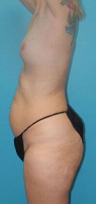 Before Image: Mommy Makeover: Case 10 - left-side